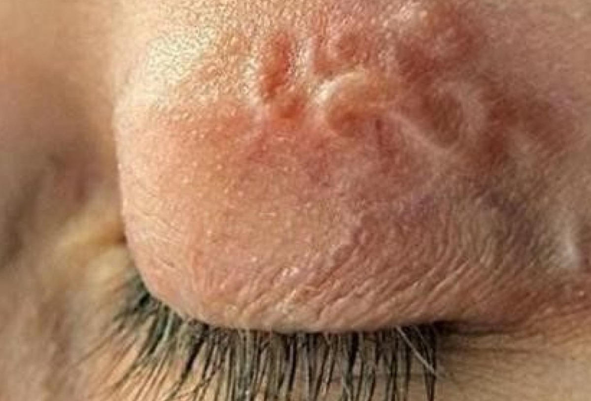 На Харківщині у жінки з ока дістали 9-сантиметрового гельмінта