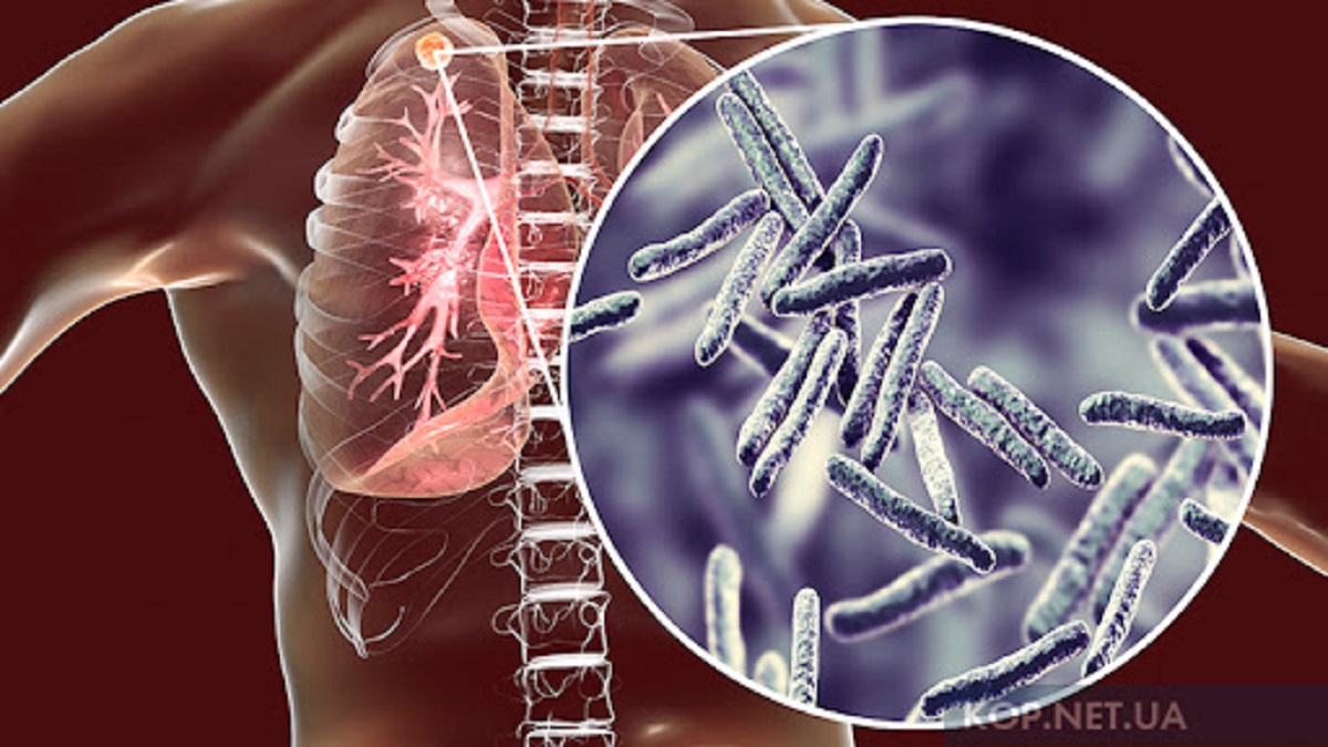 Війна сприяє розвитку туберкульозу серед жителів Харківщини